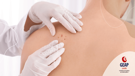 Dezembro Laranja: prevenção contra o câncer de pele!